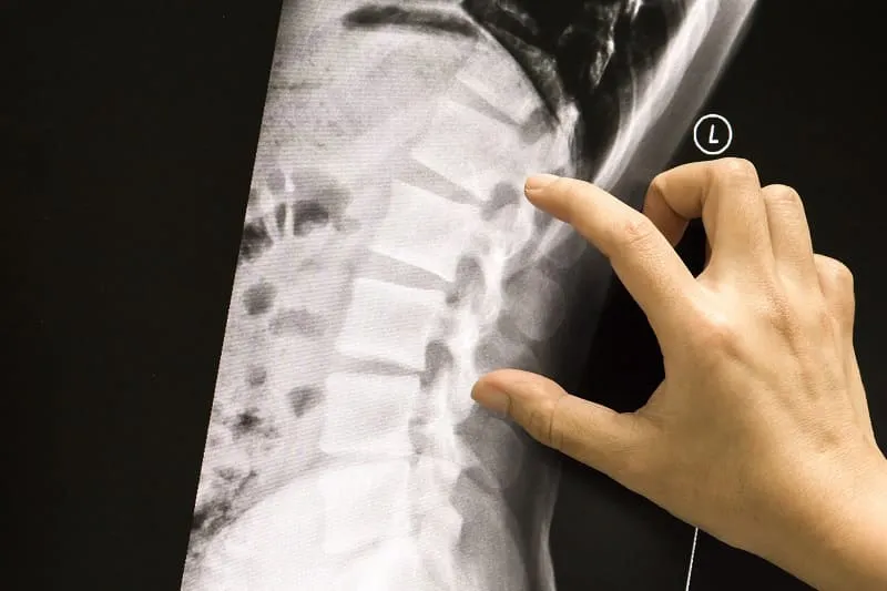 Osteoporosis ofrecido por Dr. Diego Zavala Van Rankin